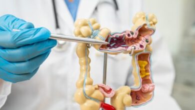 Photo of खराब लाइफस्टाइल बढ़ाती है कोलन कैंसर का जोखिम