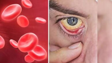 Photo of एनीमिया होने पर शरीर इन तरीकों से देता है चेतावनी…