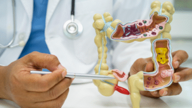 Photo of मिलेनियल्स में तेजी से बढ़ रहा है अपेंडिक्स कैंसर का खतरा