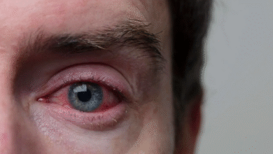 Photo of जिसे साधारण एलर्जी समझ रहे हैं, कहीं वो अर्बन आई सिंड्रोम तो नहीं?