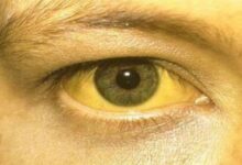 Photo of हरियाणा के इस जिले में 16 बच्चों में मिले पीलिया के लक्षण