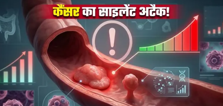 Photo of आंतों में इन दो तरह की गांठ से 5 गुना तक बढ़ जाता है कैंसर का खतरा