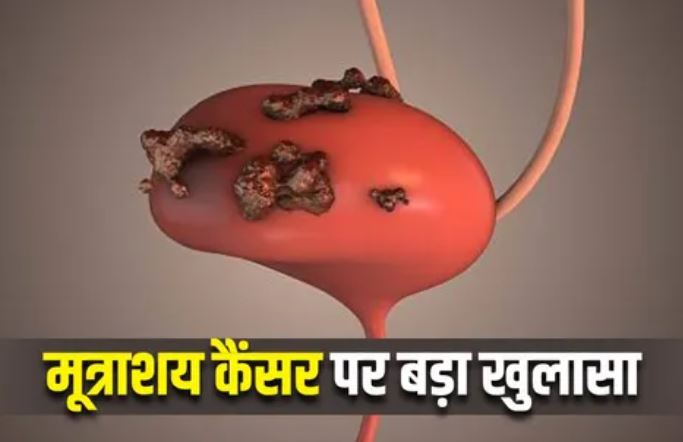 Photo of सर्जरी के बाद रेडिएशन थेरेपी से आधा हो जाता है Bladder Cancer का खतरा
